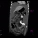 Crohn's disease, stenosis, rupture, routine CT at 3 years: CT - Computed tomography