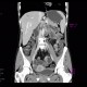 Crohn's disease, stenosis, prestenotic dilatation, CT enterography at 3 years: CT - Computed tomography