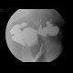Inflammatory stenosis of sigmoid colon, sigmoid fistula, irrigography: RF - Fluoroscopy