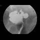 Inflammatory stenosis of sigmoid colon, sigmoid fistula, irrigography: RF - Fluoroscopy
