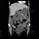 Crohn's disease, terminal ileum, stenosis, CT enterography: CT - Computed tomography