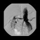 Stenosis of renal artery, stent: AG - Angiography