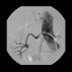 Stenosis of renal artery, stent: AG - Angiography