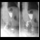 Stomach resection, Billroth II: RF - Fluoroscopy