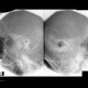 Schuller view, antrotomy: X-ray - Plain radiograph