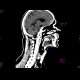 Subarachnoid hemorrhage: CT - Computed tomography