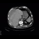 Subcapsular hematoma of the liver: CT - Computed tomography