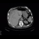Subcapsular hematoma of the liver: CT - Computed tomography