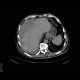Subcapsular hematoma of the liver: CT - Computed tomography