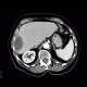 Subdiaphragmatic abscess, abscess: CT - Computed tomography