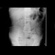 Subileus: X-ray - Plain radiograph
