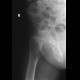 Subcapital fracture of the left femur: X-ray - Plain radiograph