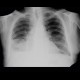 Pleural effusion, subpulmonal: X-ray - Plain radiograph