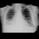 Pleural effusion, subpulmonal: X-ray - Plain radiograph