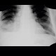 Pleural effusion, subpulmonal: X-ray - Plain radiograph