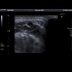 Suppurative sialoadenitis: US - Ultrasound
