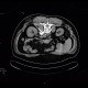 Sympatectomy, alcohol ablation of the coeliac ganglion, CT guided: CT - Computed tomography