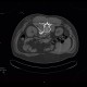 Sympatectomy, alcohol ablation of the coeliac ganglion, CT guided: CT - Computed tomography
