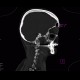 Synostosis of atlas and occipital condyli, C1, C0: CT - Computed tomography