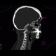 Synostosis of atlas and occipital condyli, C1, atlas, C0: CT - Computed tomography
