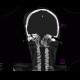 Synostosis of atlas and occipital condyli, C1, atlas, C0: CT - Computed tomography