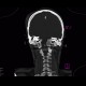Synostosis of atlas and occipital condyli, C1, atlas, C0: CT - Computed tomography