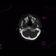Synostosis of atlas and occipital condyli, C1, atlas, C0: CT - Computed tomography