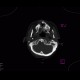 Synostosis of atlas and occipital condyli, C1, atlas, C0: CT - Computed tomography