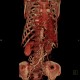Takayashu arteritis: CT - Computed tomography