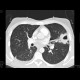 Lung tuberculosis, cavern, endobronchial spread, tree-in-bud: CT - Computed tomography