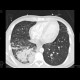 Lung tuberculosis, cavern, endobronchial spread, tree-in-bud: CT - Computed tomography