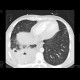 Lung tuberculosis, cavern, endobronchial spread, tree-in-bud: CT - Computed tomography