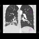 Lung tuberculosis, cavern, endobronchial spread, tree-in-bud: CT - Computed tomography