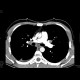 Lung tuberculosis, cavern, endobronchial spread, tree-in-bud: CT - Computed tomography