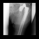 Hip replacement, dislocation: X-ray - Plain radiograph