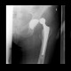 Hip replacement, dislocation: X-ray - Plain radiograph