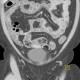 Ovarian teratoma: CT - Computed tomography