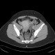 Ovarian teratoma: CT - Computed tomography