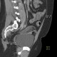 Ovarian teratoma: CT - Computed tomography