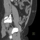 Ovarian teratoma: CT - Computed tomography
