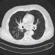 Terminal bronchiolitis, tree-in-bud: CT - Computed tomography