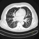 Terminal bronchiolitis, tree-in-bud: CT - Computed tomography