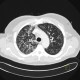 Terminal bronchiolitis, tree-in-bud: CT - Computed tomography