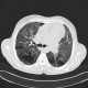 Lung fibrosis, severe: CT - Computed tomography