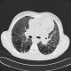 Lung fibrosis, severe: CT - Computed tomography