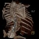 Scoliosis, severe, VRT: CT - Computed tomography