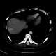 Transient hepatic attenuation difference, liver, THAD: CT - Computed tomography