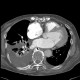 Thrombosis of the pulmonary vein: CT - Computed tomography