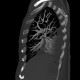 Thrombosis of the pulmonary vein: CT - Computed tomography