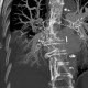 Thrombosis of the pulmonary vein: CT - Computed tomography